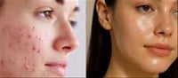 🌞 Struggling With Summer Breakouts? Here’s How to Get Rid of Acne